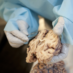 Boston University Center for the Study of Traumatic Encephalopathy CSTE, Ann McKee, chronic traumatic encephalopathy, CTE, brain research, neurological research, football head trauma, athletics head trauma, hockey head trauma
