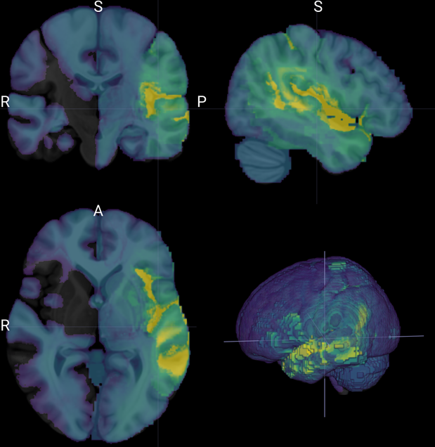 Brain Scans provided by Emerson Kropp. 4 images in total showing different sides of the brain.