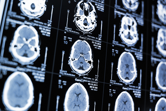 Marlene Oscar Berman, Susan Mosher Ruiz, Boston University School of Medicine, neurobiology, neurology, neuroscience, alcoholism effects on the human brain, how alcohol effects the brain, alcoholism and gender