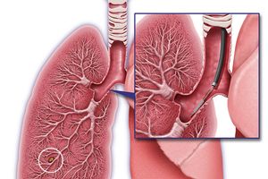 PerceptaTM early lung cancer detection device