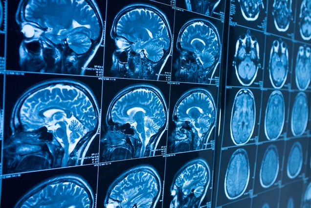 MRI images of human brain