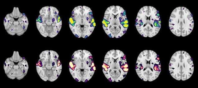MRI scan brain images showing parts of the brain activated by hearing human speech