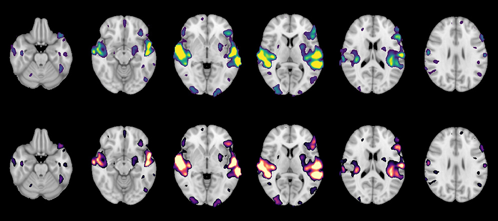 MRI scan brain images showing parts of the brain activated by hearing human speech