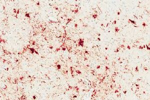 Microscopic image of high accumulations of p-tau in the brain tissue of a deceased person with the "major" genetic variation of the TMEM106B protein.