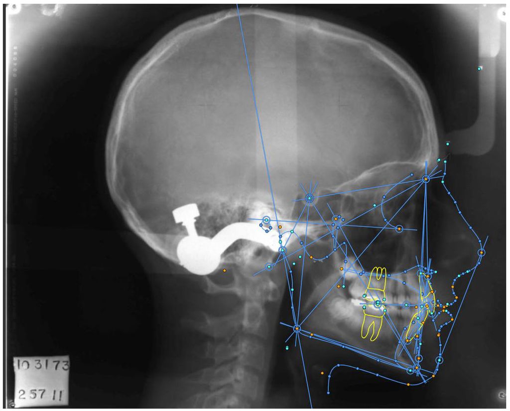 Each dot on this patient’s x-ray represents a “landmark,” which are all automatically identified, labeled, and measured within seconds with the software. Courtesy of Melih Motro