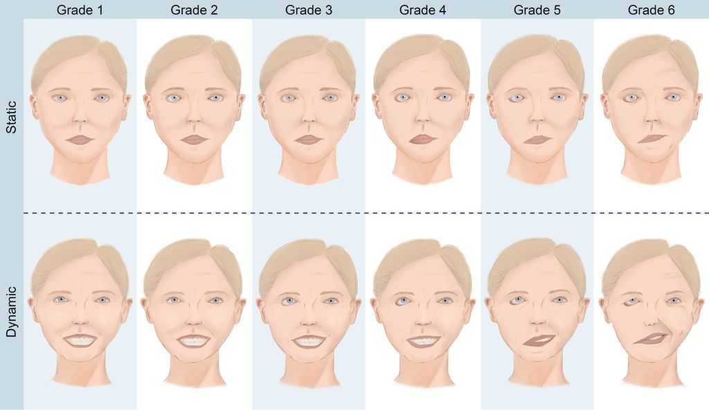 Illustrations showing the House-Brackmann scale, a classification used to grade stages of facial paralysis.