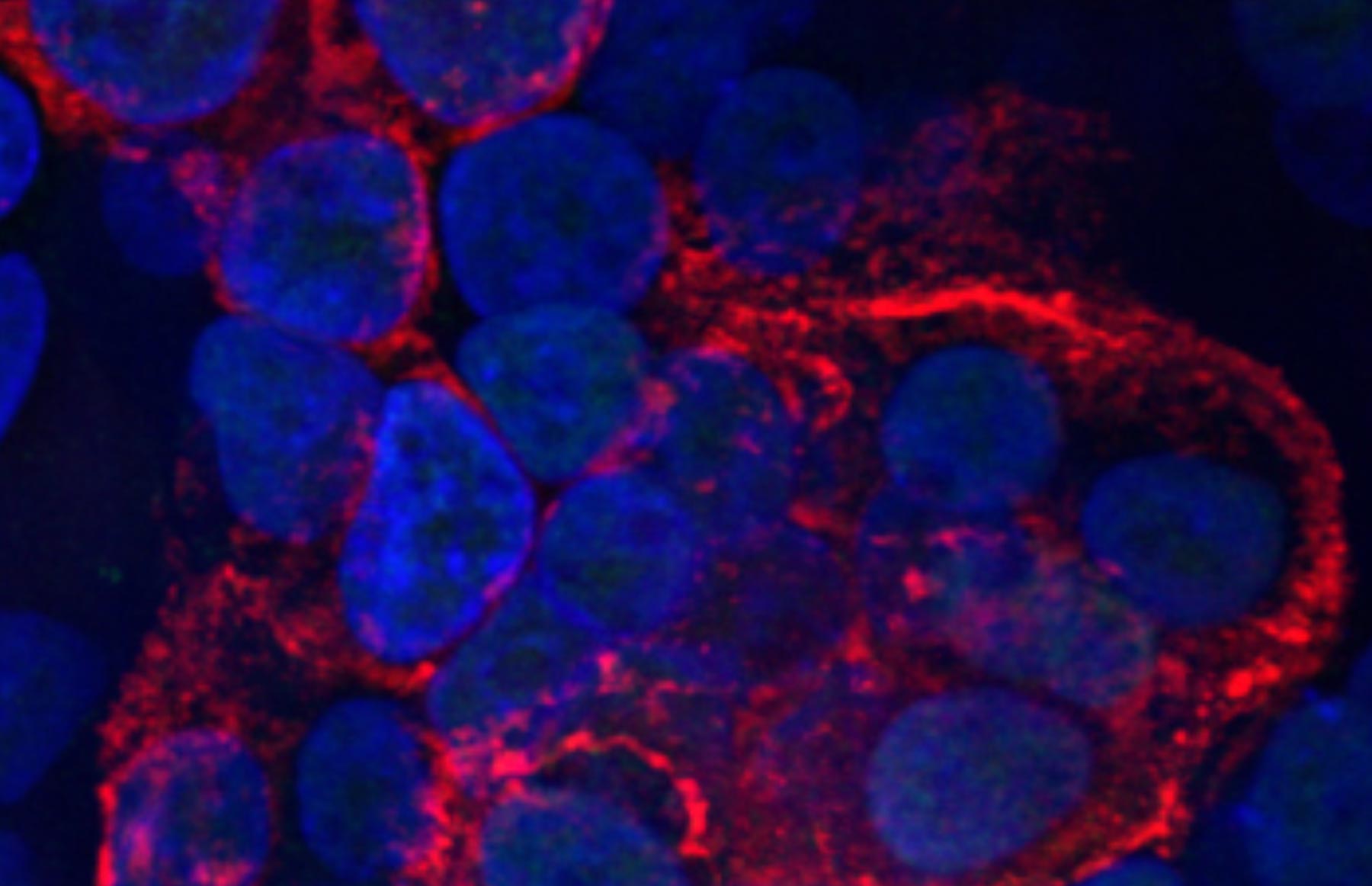 Microscopic image of human lung cells infected with COVID-19 coronavirus