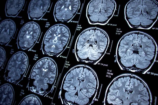 Photo of a series of black and grey brain scans.