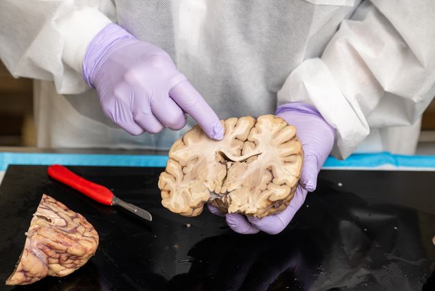 Photo: Dr Ann McKee at the CTE Brian Bank at the VA Hospital holding a brain specimen and pointing to a specific area of the brain.