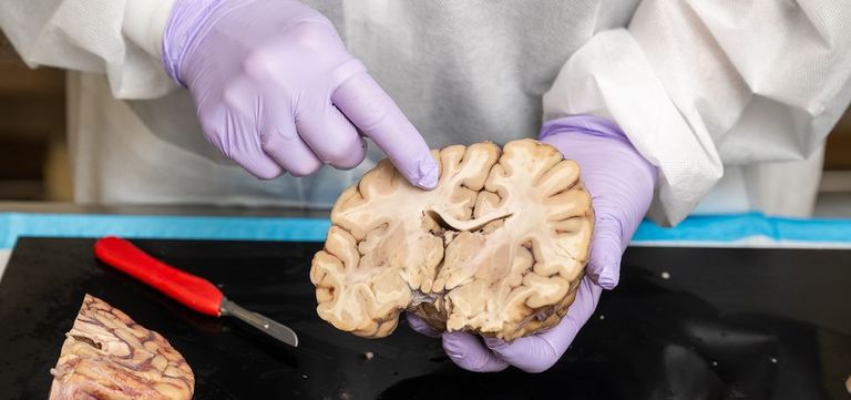 Woman holding STE brain