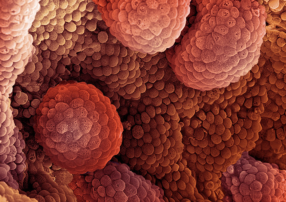 Prostate Cancer Cells under a scanning electron microscope