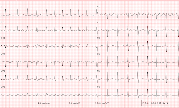 ECG example of a pathological 12-lead rhythm, atrial flutter