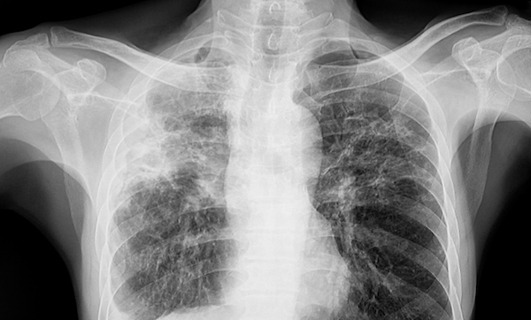 Chest x ray of a patient with tuberculosis lungs